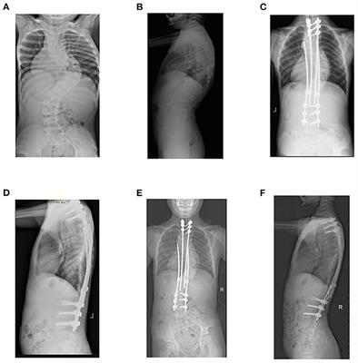 Efficacy of the growing rod technique on kyphotic early-onset scoliosis